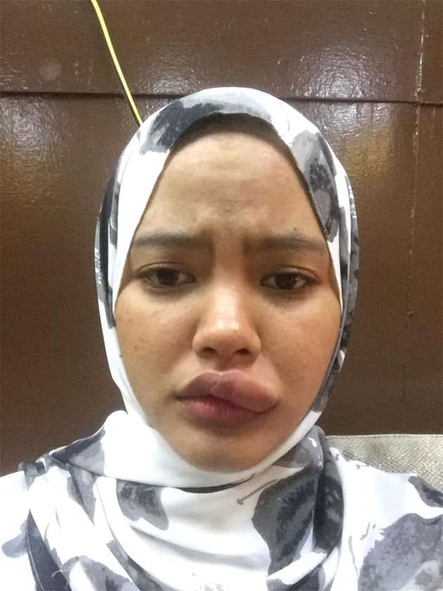 Bengkak di bibirnya makin parah.