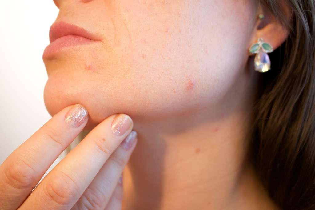 Penyakit Rubella
