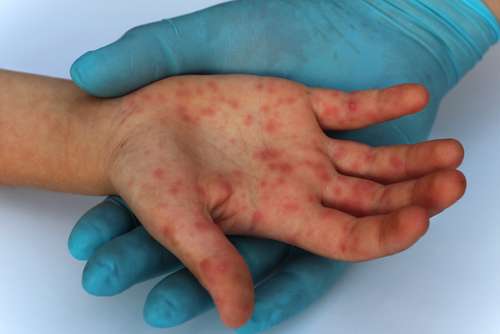 Penyakit Rubella