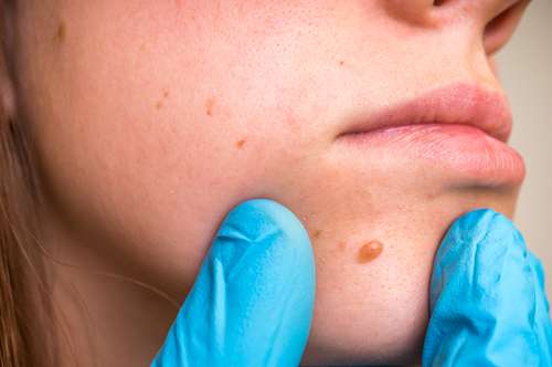 Skin Tag