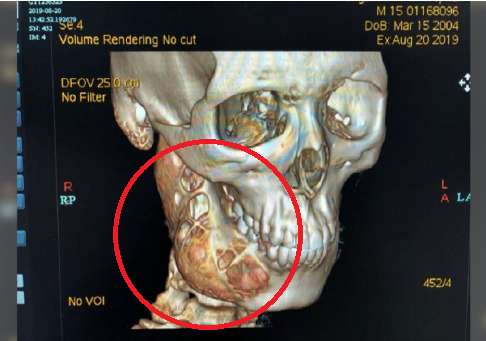 Tumor