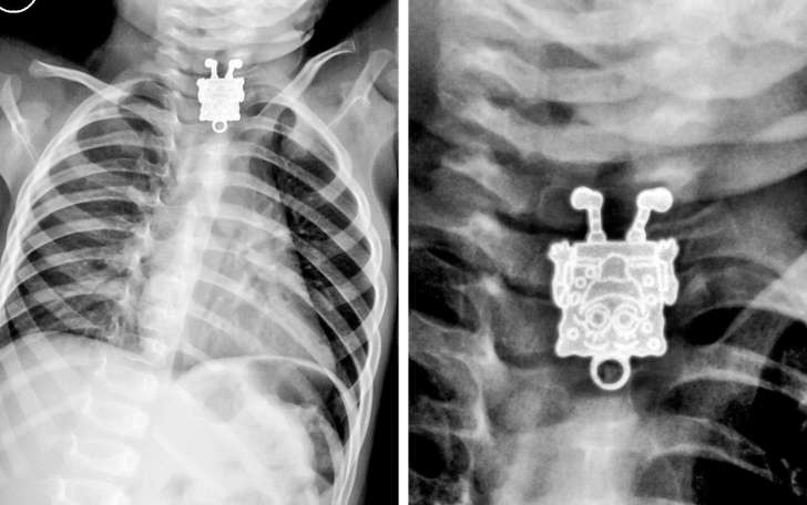 X-ray