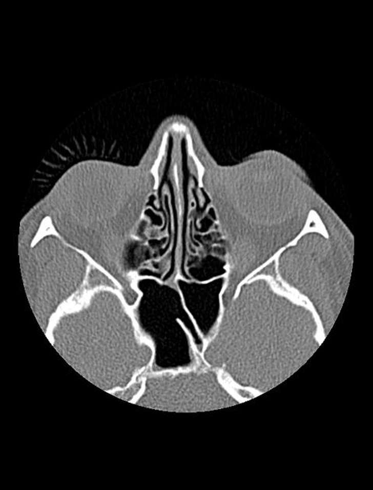 X-ray