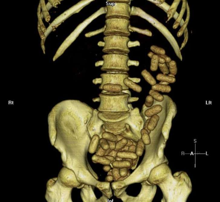 X-ray