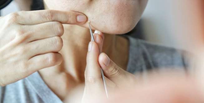 ekstraksi komedo ekstraksi komedo