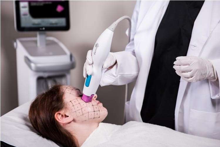 Thermage FLX