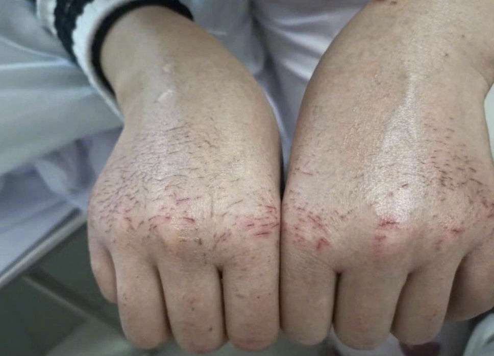 Kondisi perawat yang tangani virus Corona