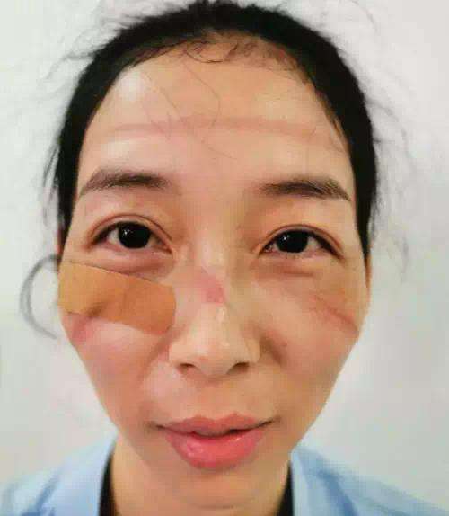 Wajah penuh bekas luka dan tanda setelah merawat pasien virus corona.
