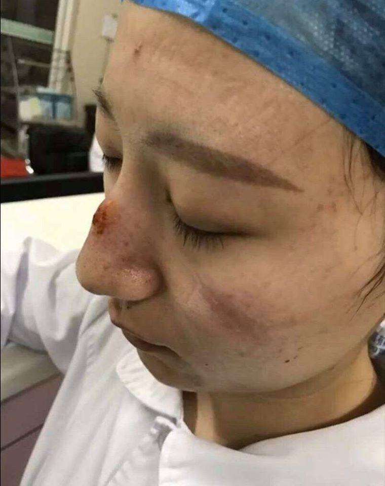 Kondisi wajah petugas medis setelah berjuang melawan virus corona.