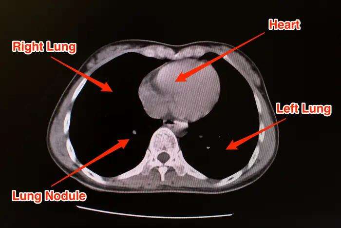 Kondisi paru-paru yang normal akan berwarna hitam saat dilakukan pemindaian CT scan.