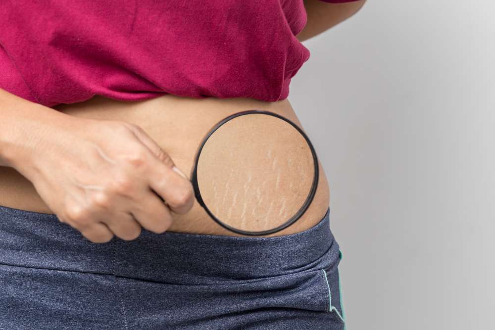 ilustrasi strech mark