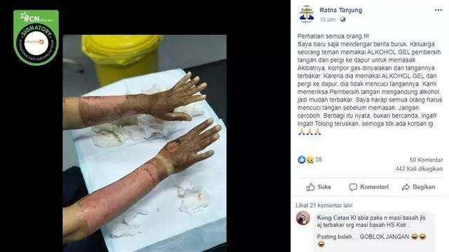 Hand sanitizer bisa menyebabkan tangan terbakar?