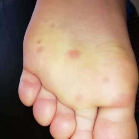 memar di kaki tanda covid-19