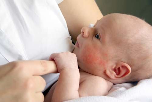Ruam Susu/Eksim/Dermatitis Atropik
