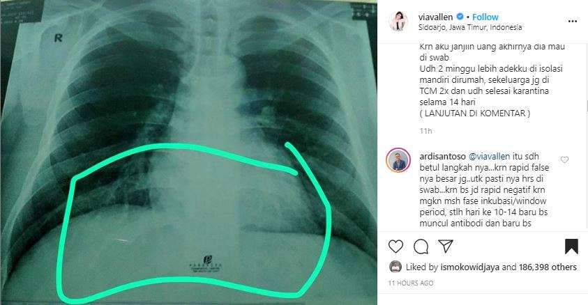 Foto paru-paru adik Via Vallen