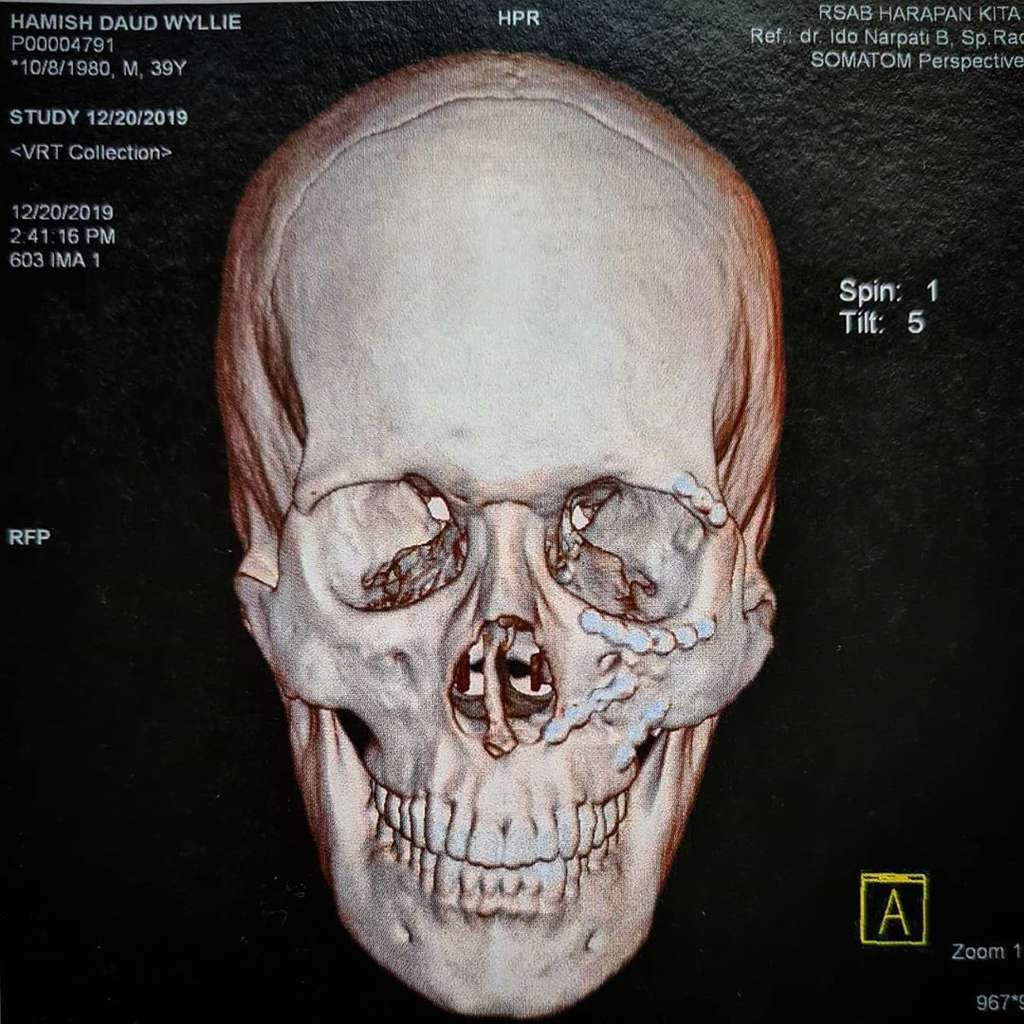 Foto X-Ray Tengkorak Kepala Hamish Daud