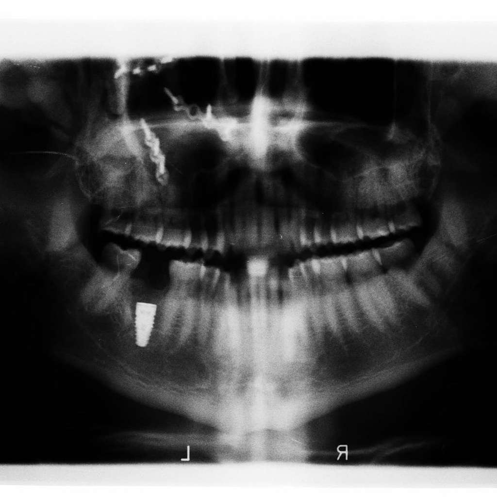 Foto X-Ray Tengkorak Kepala Hamish Daud