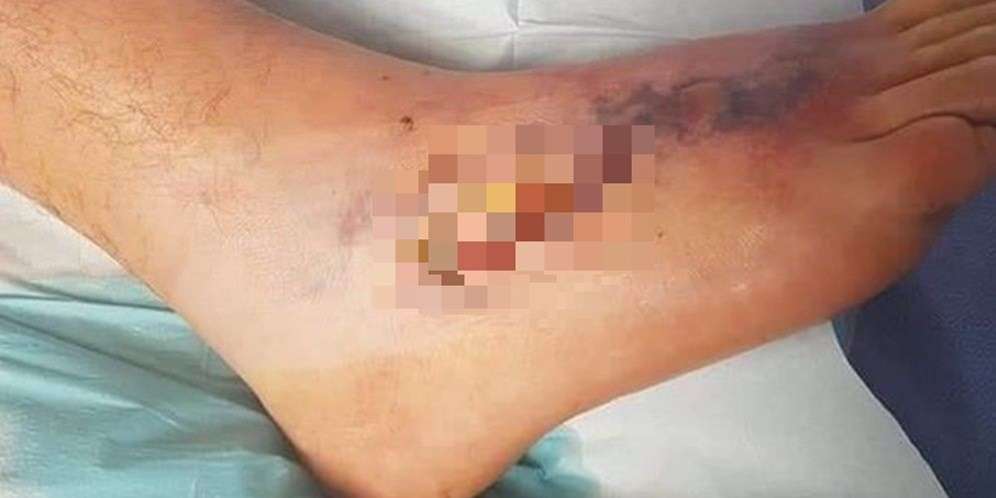 Kondisi Kaki Robbie setelah terserang serangga