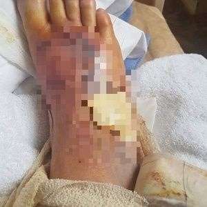 Kondisi Kaki Robbie setelah pencangkokan kulit