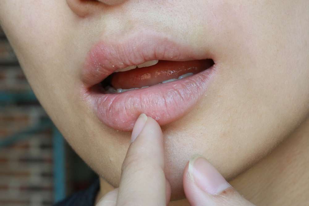 Bibir Kering