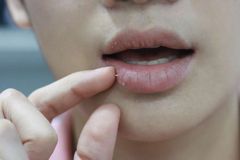 Bibir Gatal