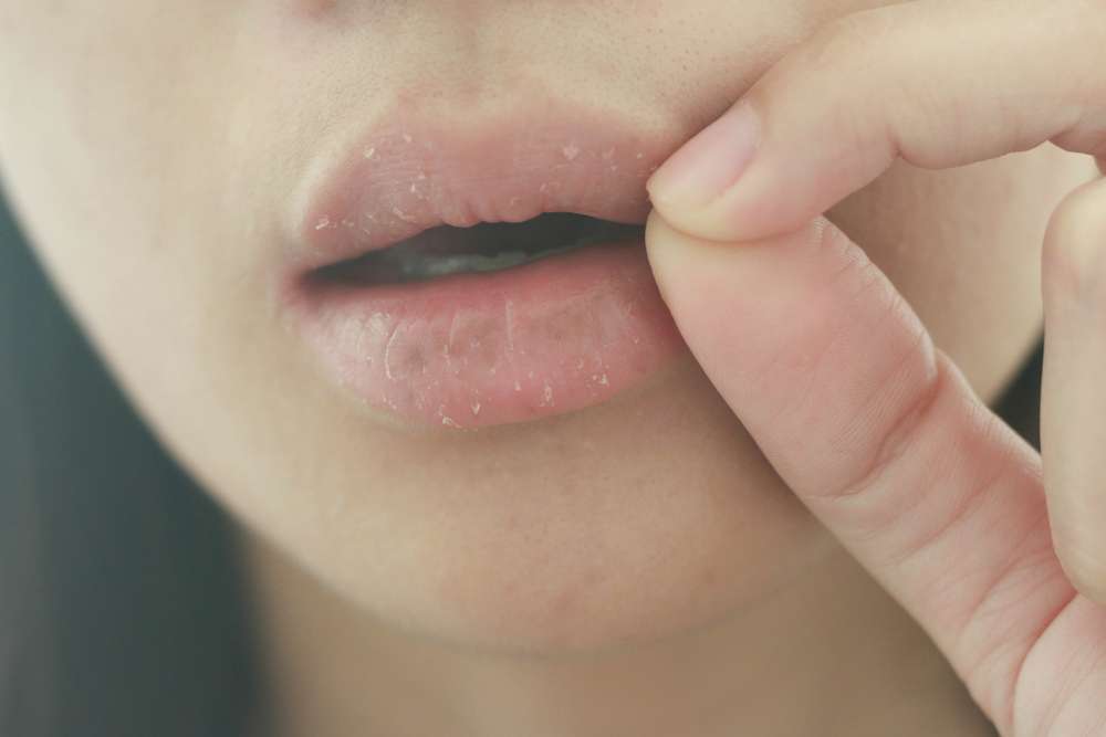Bibir Kering