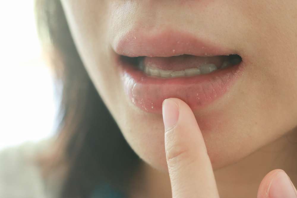 Bibir Kering