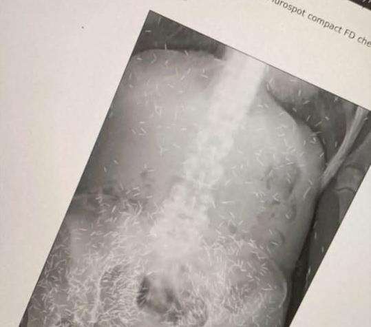 Ratusan susuk (garis warna putih) di tubuh pasien berusia 55 tahun.