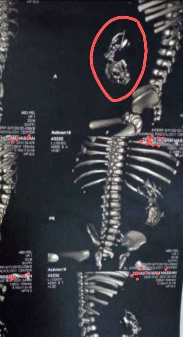 Penemuan benda asing di perut bayi Penemuan benda asing di perut bayi