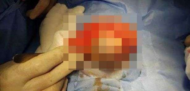 Proses operasi pada bayi yang 'hamil kembarannya' di mesir Proses operasi pada bayi yang 'hamil kembarannya' di mesir