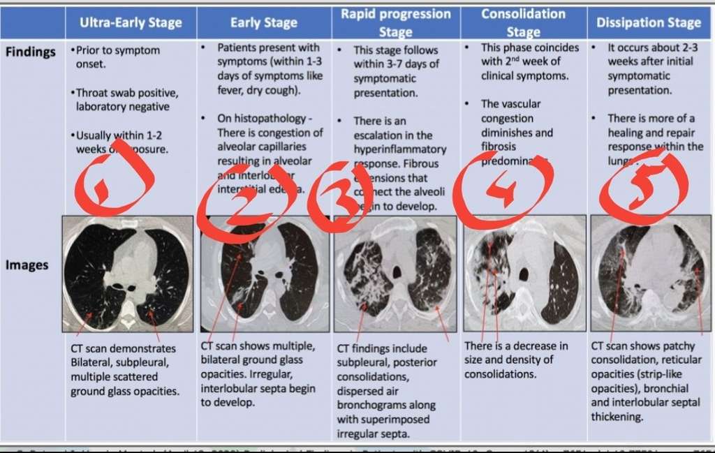 CT Scan Paru Pasien Covid