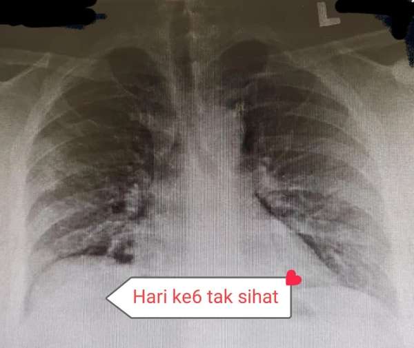 Kondisi paru hari keenam Kondisi paru hari keenam