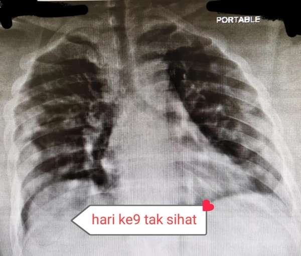 Kondisi paru hari kesembilan Kondisi paru hari kesembilan