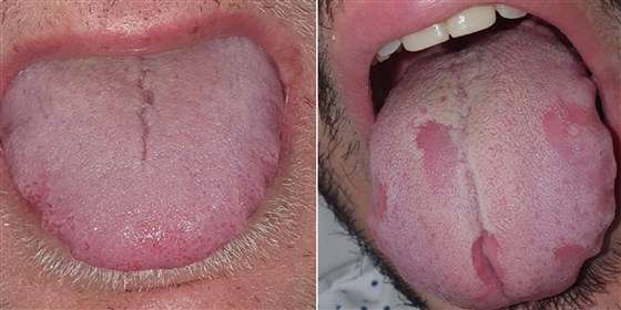 Tongue Covid