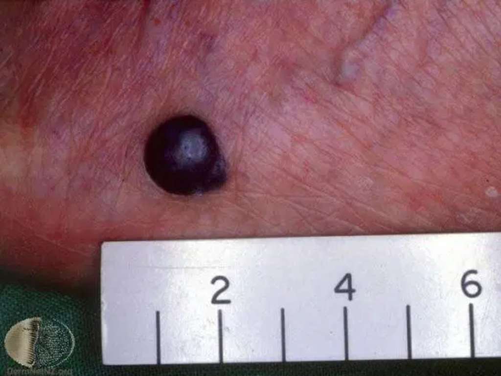 Spitz nevus