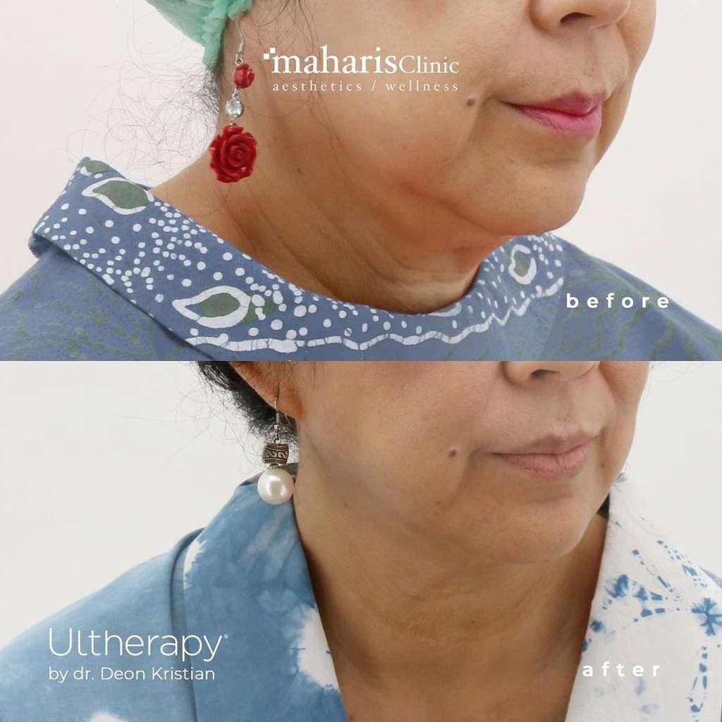 ultherapy