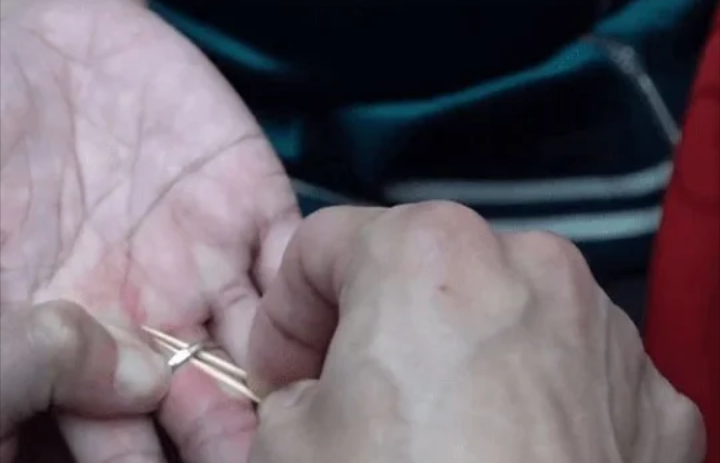 Melepaskan Cincin dengan Berbagai Cara