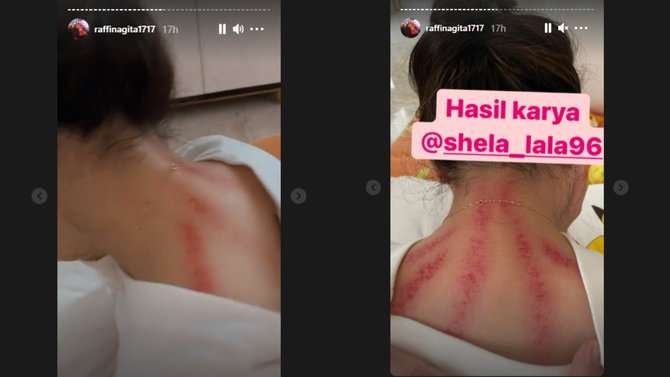 Nagita Slavina kerokan Nagita Slavina kerokan