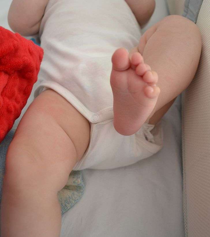 Bayi Tidak Memiliki Tempurung Lutut