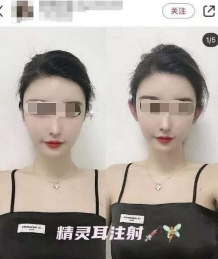 Hasil Operasi 'Elf Ear'