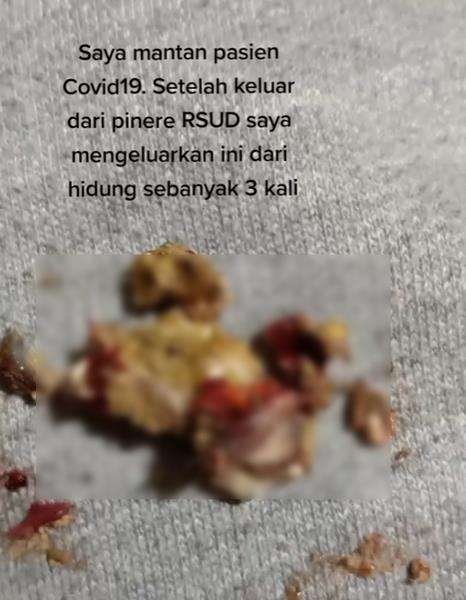 Usai jalani rawat inap mantan pasien Covid keluar gumpalan kerak kotoran hidung.