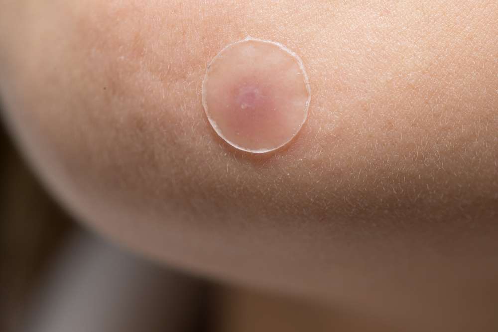 Menggunakan Pimple Patch