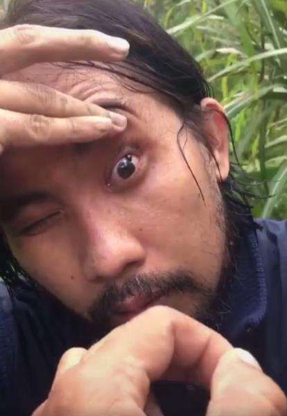 Lintah menempel di dalam kelopak matanya.