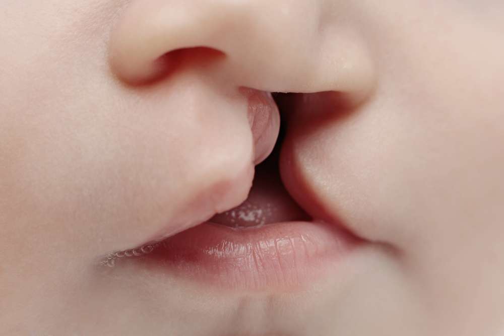 Bibir Sumbing Pada Anak