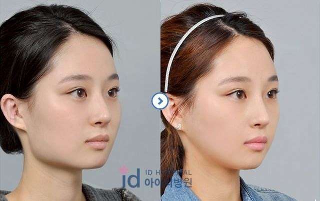 Jaw reduction