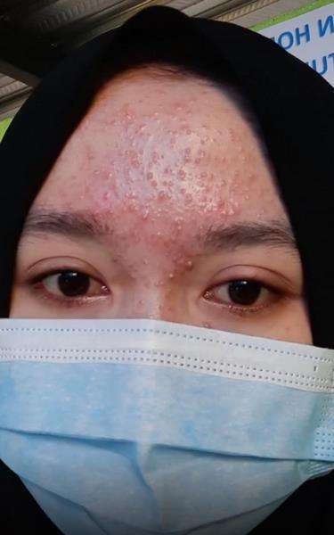 Cerita cewek mukanya 'hancur' usai pakai masker gara-gara tertarik iklan.