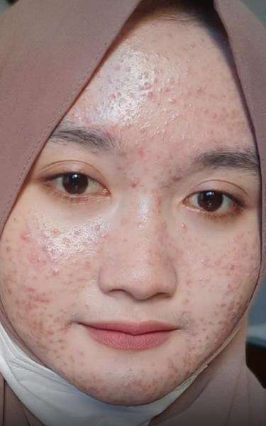 Cerita cewek mukanya 'hancur' usai pakai masker gara-gara tertarik iklan.