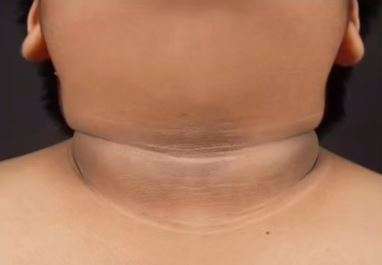 Kondisi kulit saat diabetes