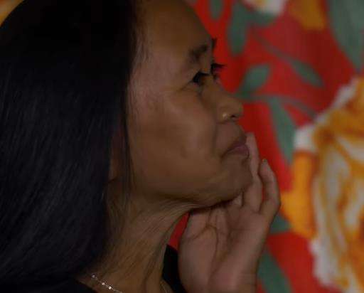 Idap penyakit langka, gadis 16 tahun terlihat seperti wanita 50 tahun