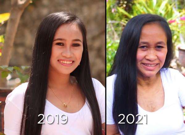 Idap penyakit langka, gadis 16 tahun terlihat seperti wanita 50 tahun